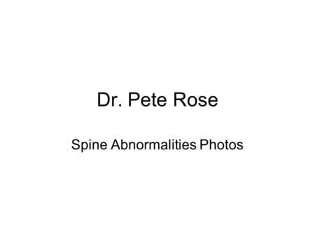 Dr. Pete Rose Spine Abnormalities Photos. Scoliosis Abnormal curve of the spine in the frontal plane –Present in 1/3 rd of patients –Equally present in.