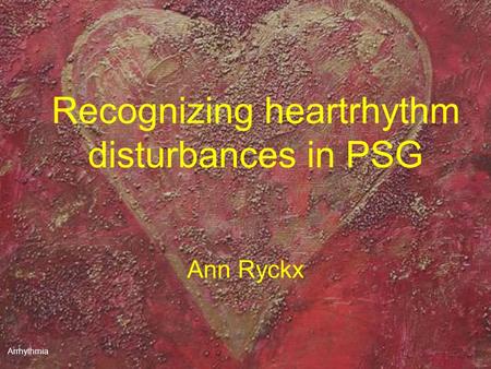 Recognizing heartrhythm disturbances in PSG