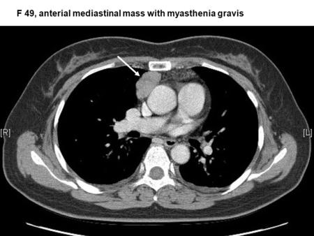 F 49, anterial mediastinal mass with myasthenia gravis.