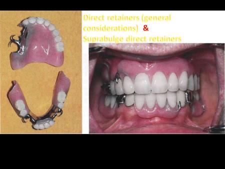 Direct retainers (general considerations)  &