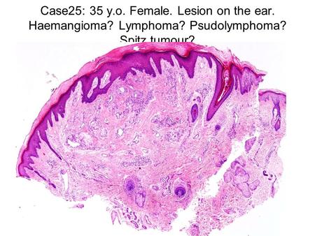 Case25: 35 y.o. Female. Lesion on the ear. Haemangioma? Lymphoma? Psudolymphoma? Spitz tumour?