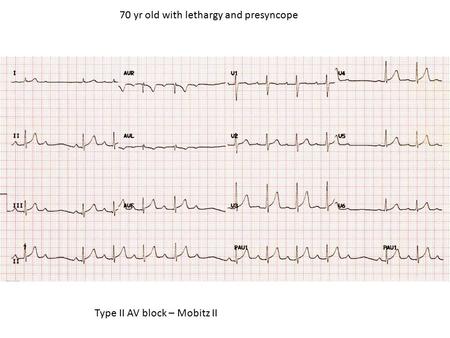 70 yr old with lethargy and presyncope