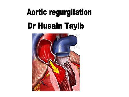 Aortic regurgitation Dr Husain Tayib.