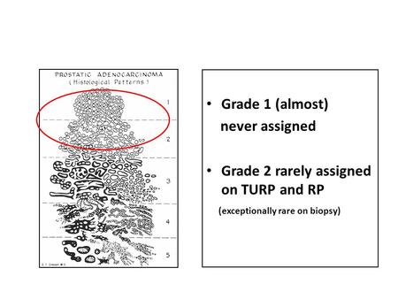 Grade 1 (almost) never assigned Grade 2 rarely assigned on TURP and RP (exceptionally rare on biopsy)