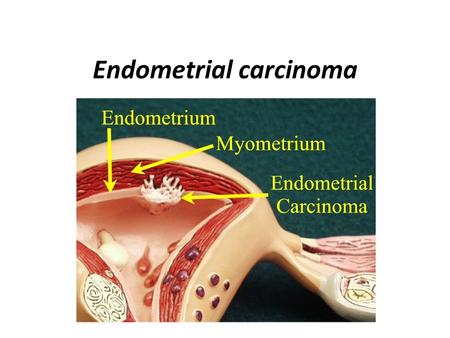 Endometrial carcinoma. Endometrial carcinoma is the fifth leading cancer in the women worldwide. In developed countries it’s the most common gynaecological.