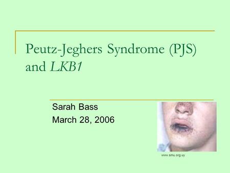 Peutz-Jeghers Syndrome (PJS) and LKB1 Sarah Bass March 28, 2006 www.smu.org.uy.