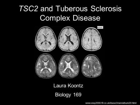 TSC2 and Tuberous Sclerosis Complex Disease www.xray2000.f9.co.uk/ibase3/rain/album20.html Laura Koontz Biology 169.