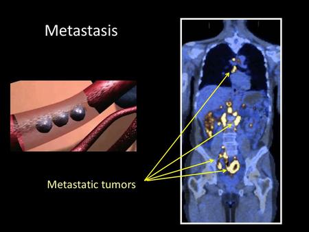 Metastasis Figure 20-1 Molecular Biology of the Cell (© Garland Science 2008) Metastatic tumors.