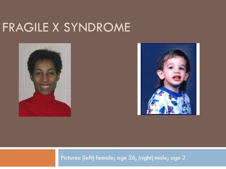 FRAGILE X SYNDROME Pictures: (left) female; age 26, (right) male; age 2.