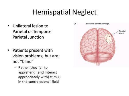 Hemispatial Neglect Unilateral lesion to Parietal or Temporo- Parietal Junction Patients present with vision problems, but are not “blind” – Rather, they.