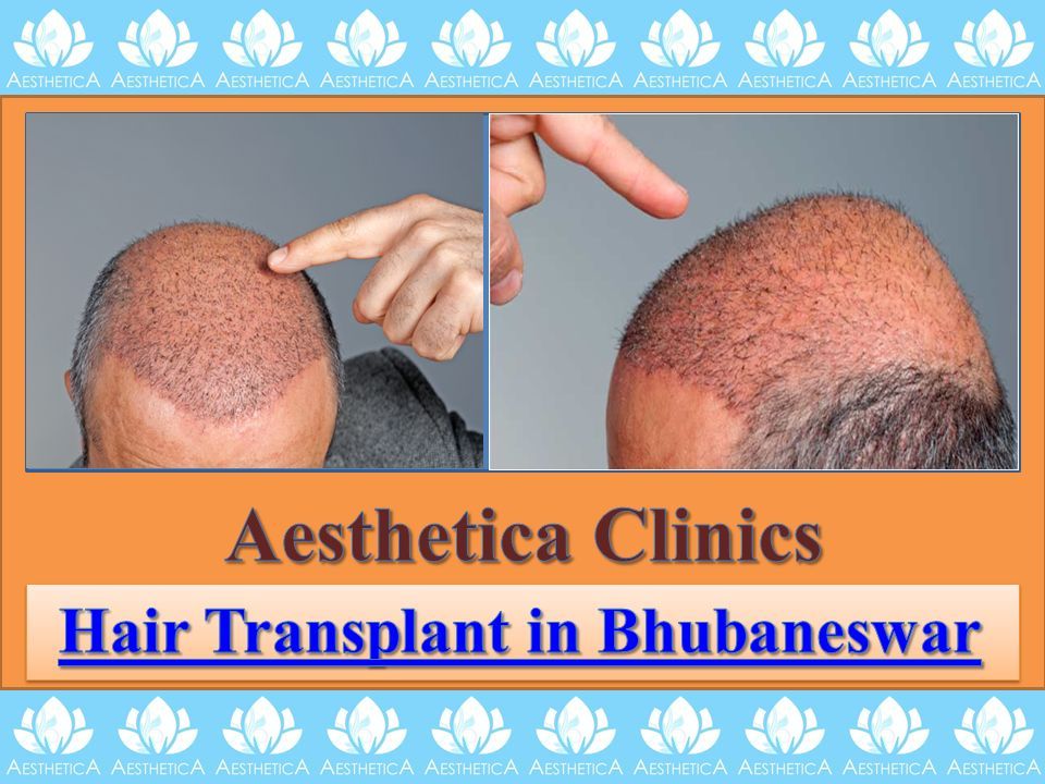 Are you looking for Hair Transplant in Bhubaneswar? Aesthetica Clinics is  the World No. 1 Ranked Hair Transplant Clinic in Bhubaneswar, providing Hair.  - ppt download
