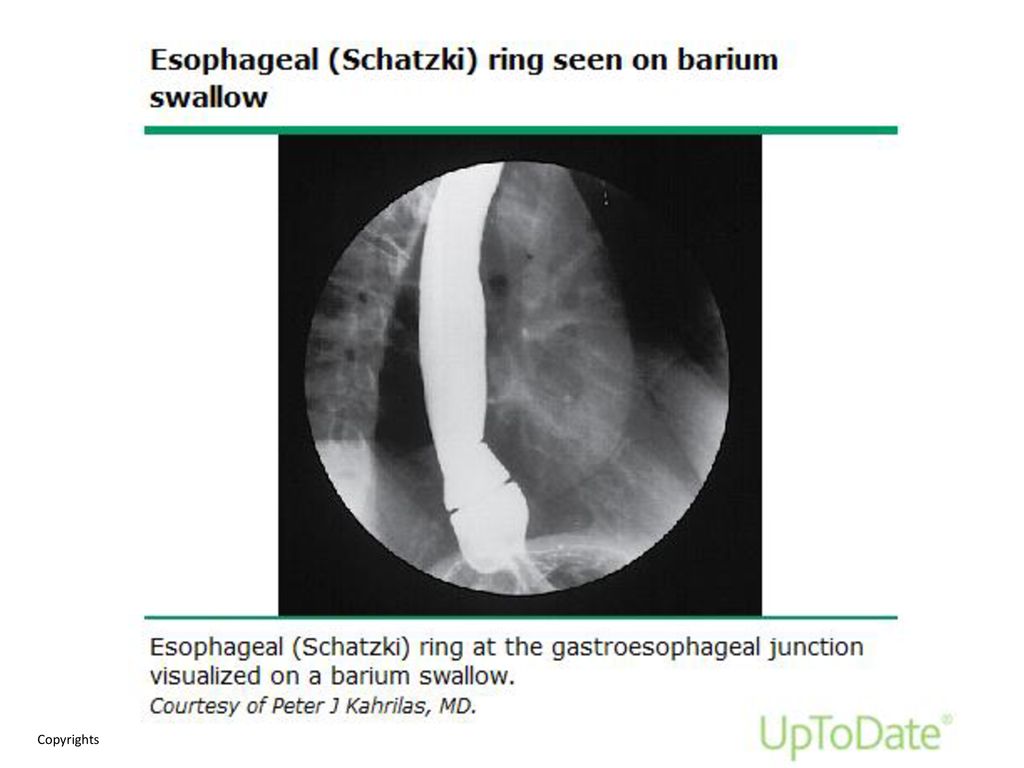 Schatzki Ring - radRounds Radiology Network