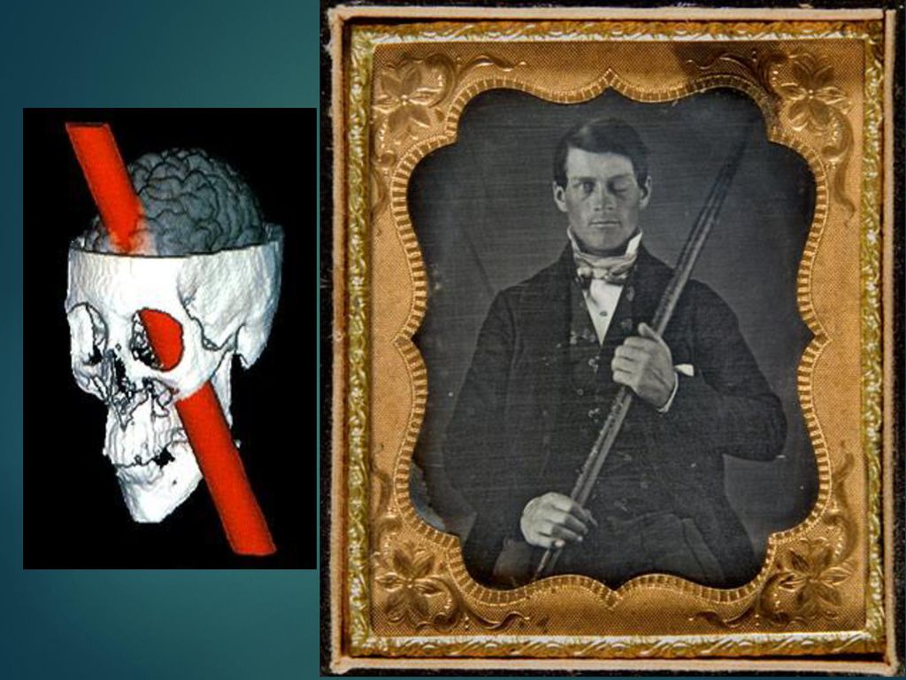 phineas gage study ib psychology
