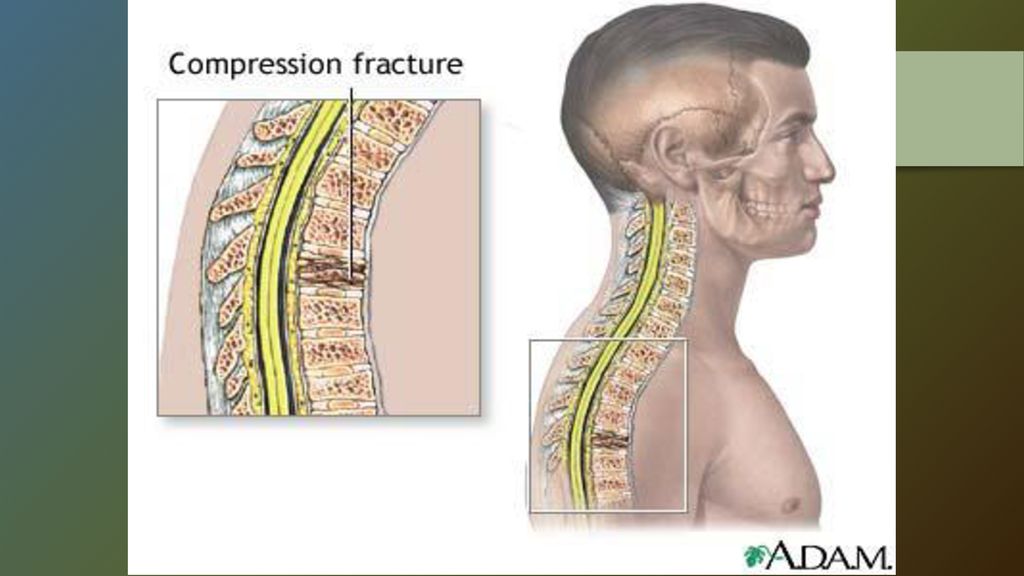 Компрессионный перелом позвоночника что это такое у детей фото и последствия