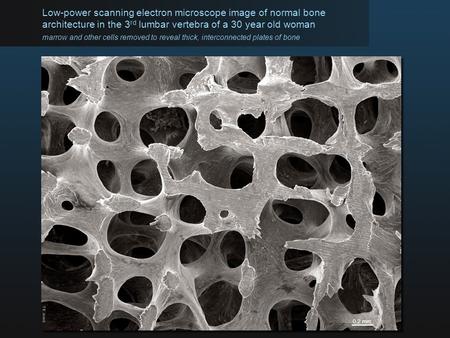 Low-power scanning electron microscope image of normal bone architecture in the 3 rd lumbar vertebra of a 30 year old woman marrow and other cells removed.