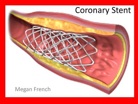 Coronary Stent Megan French. What is a Stent A small, mesh-like device made of metal Acts as a support or scaffold, in keeping the vessel open Stent helps.