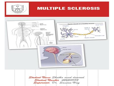 Multiple Sclerosis Definition: Multiple sclerosis (MS) is a disease of the central nervous system (CNS); it damages the protective coating around the.