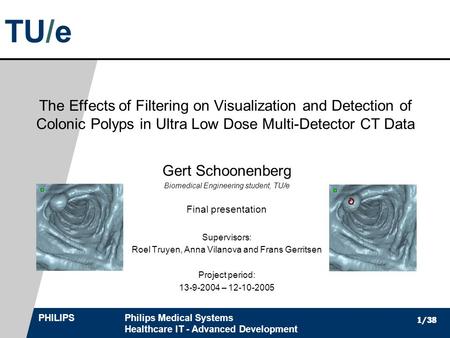 TU/e PHILIPSPhilips Medical Systems Healthcare IT - Advanced Development 1/38 The Effects of Filtering on Visualization and Detection of Colonic Polyps.