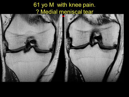 61 yo M with knee pain. ? Medial meniscal tear.