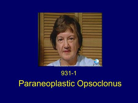 Paraneoplastic Opsoclonus 931-1. History In July 1986 a 58-year old woman presented acutely with nausea, vertigo, difficulty focusing and oscillopsia.