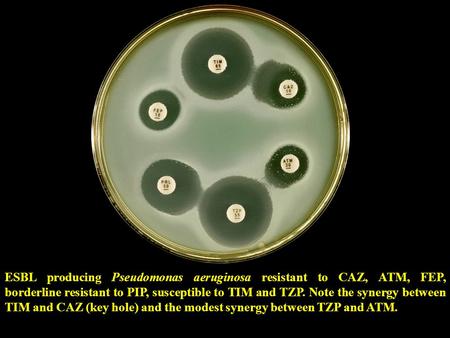 ESBL producing Pseudomonas aeruginosa resistant to CAZ, ATM, FEP, borderline resistant to PIP, susceptible to TIM and TZP. Note the synergy between TIM.