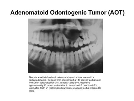 Adenomatoid Odontogenic Tumor (AOT) There is a well-defined unilocular oval shaped radiolucence with a corticated margin. It extend from apex of tooth.