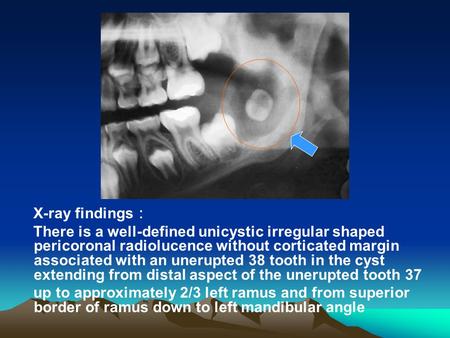 X-ray findings ： There is a well-defined unicystic irregular shaped pericoronal radiolucence without corticated margin associated with an unerupted 38.