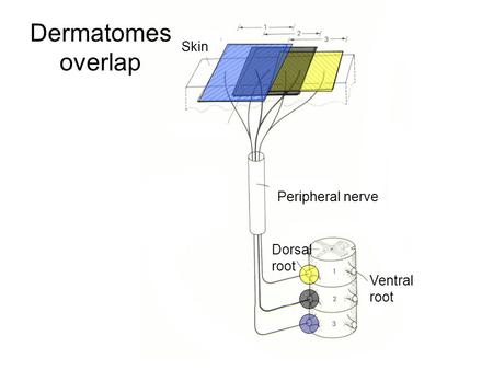 Dermatomes overlap Skin Peripheral nerve Dorsal root Ventral root.