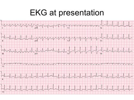 EKG at presentation. EKG next day Initial EKG F/u EKG.