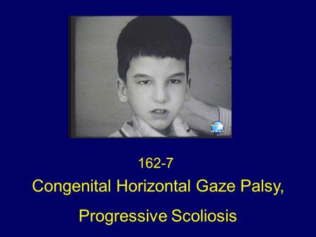 162-7 Congenital Horizontal Gaze Palsy, Progressive Scoliosis.