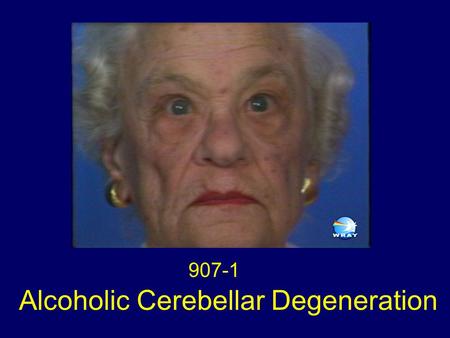 Alcoholic Cerebellar Degeneration 907-1. Clinical Syndrome The clinical syndrome of alcoholic cerebellar degeneration is remarkably stereotyped. The usual.