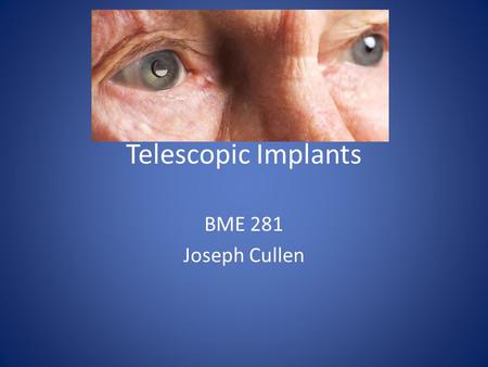 Telescopic Implants BME 281 Joseph Cullen. Macular degeneration? Effects the elderly A build up of deposits called drusen on Macula Creates blind spot.