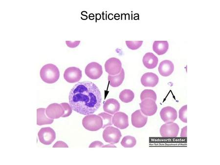 Septicemia.
