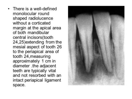 There is a well-defined monolocular round shaped radiolucence without a corticated margin at the apical area of both mandibular central incisors(tooth.