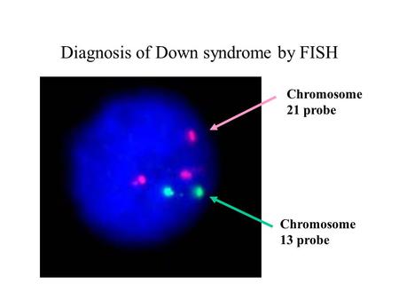 Diagnosis of Down syndrome by FISH Chromosome 13 probe Chromosome 21 probe.