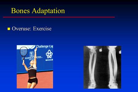 Bones Adaptation n Overuse: Exercise. Bone Adaptation n Disuse: bone mass is reduced.