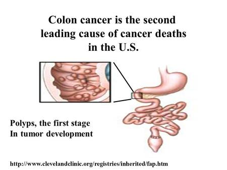 Colon cancer is the second leading cause of cancer deaths in the U.S. Polyps, the first stage In tumor development