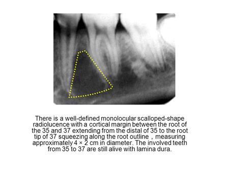 There is a well-defined monolocular scalloped-shape radiolucence with a cortical margin between the root of the 35 and 37 extending from the distal of.