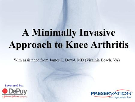 A Minimally Invasive Approach to Knee Arthritis Sponsored by: With assistance from James E. Dowd, MD (Virginia Beach, VA)