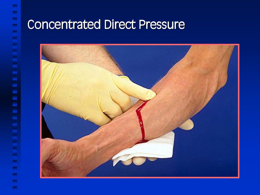 Concentrated Direct Pressure - ppt download