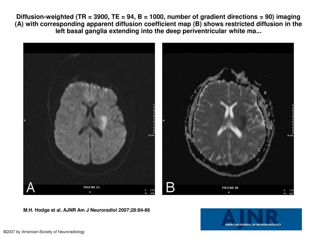 Diffusion Weighted Tr 3900 Te 94 B 1000 Number Of Gradient Directions 90 Imaging A With Corresponding Apparent Diffusion Coefficient Map Ppt Download