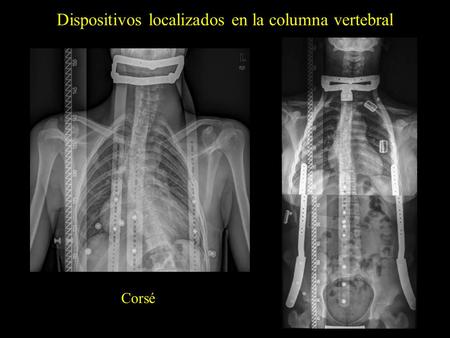 Dispositivos localizados en la columna vertebral Corsé.