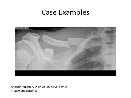Case Examples An isolated injury in an adult, bicycle crash Treatment options?