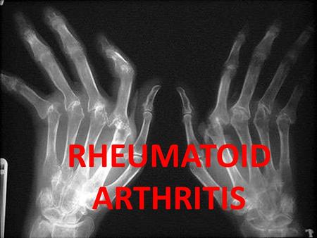 RHEUMATOID ARTHRITIS. Chronic multisystem disease of unknown cause Characteristic features: Persistent inflammatory synovitis Involves peripheral joints.