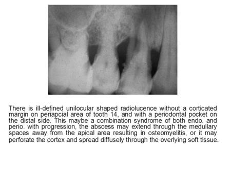 There is ill-defined unilocular shaped radiolucence without a corticated margin on periapcial area of tooth 14, and with a periodontal pocket on the distal.