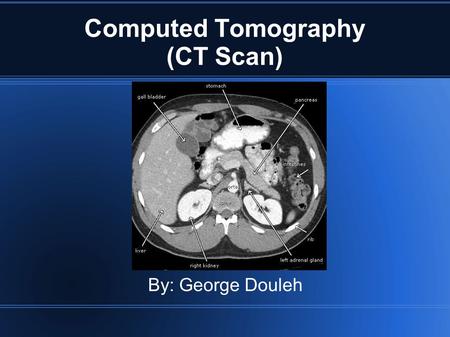 Computed Tomography (CT Scan) By: George Douleh. History CT was invented by Godfrey Hounsfield, a British Engineer and Allan Comrack, a South African.