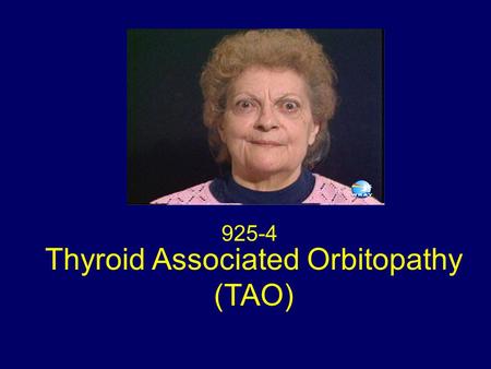 Thyroid Associated Orbitopathy (TAO) 925-4. Classical Signs : TAO A prominent stare. Retraction of all four eyelids Bilateral exophthalmos Hertel exophthalmometer.