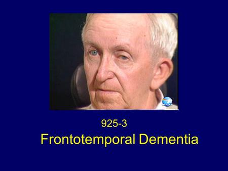 Frontotemporal Dementia 925-3. Eye Movements This patient with frontotemporal dementia (FTD) has a complete paralysis of horizontal saccadic eye movements.