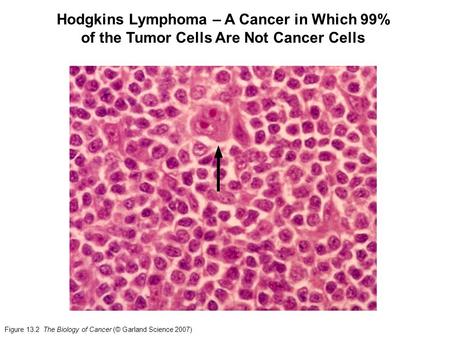 Figure 13.2 The Biology of Cancer (© Garland Science 2007) Hodgkins Lymphoma – A Cancer in Which 99% of the Tumor Cells Are Not Cancer Cells.