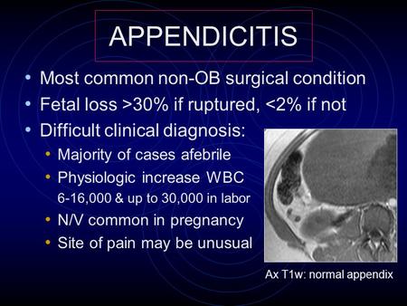 Most common non-OB surgical condition Fetal loss >30% if ruptured, 